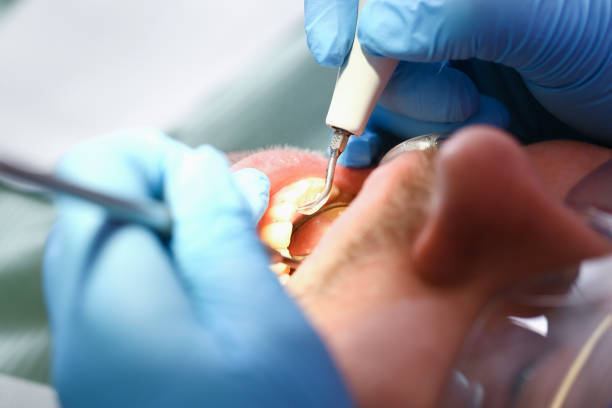 Best Broken or Chipped Tooth Repair in Connersville, IN